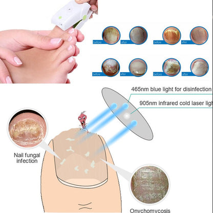 Fungus Treatment Laser Device